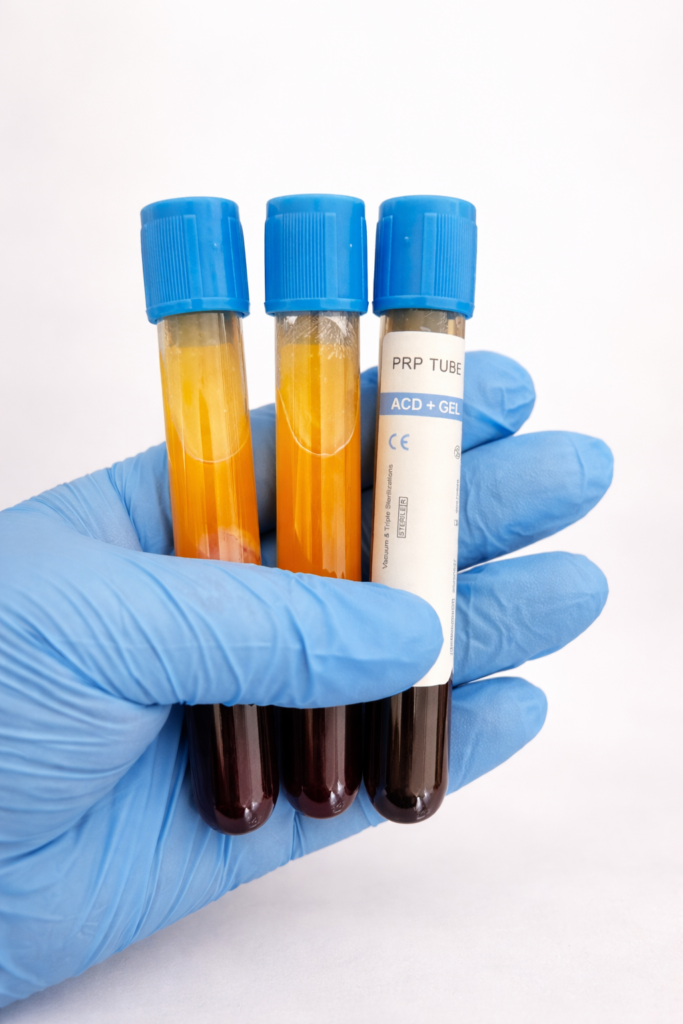 prp tube